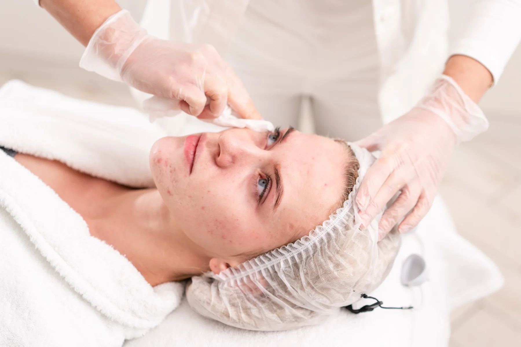 Tratamiento facial para acné en Marien Skincare Mérida